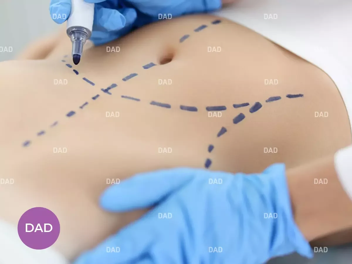 Abdominoplasty Surgery Guide