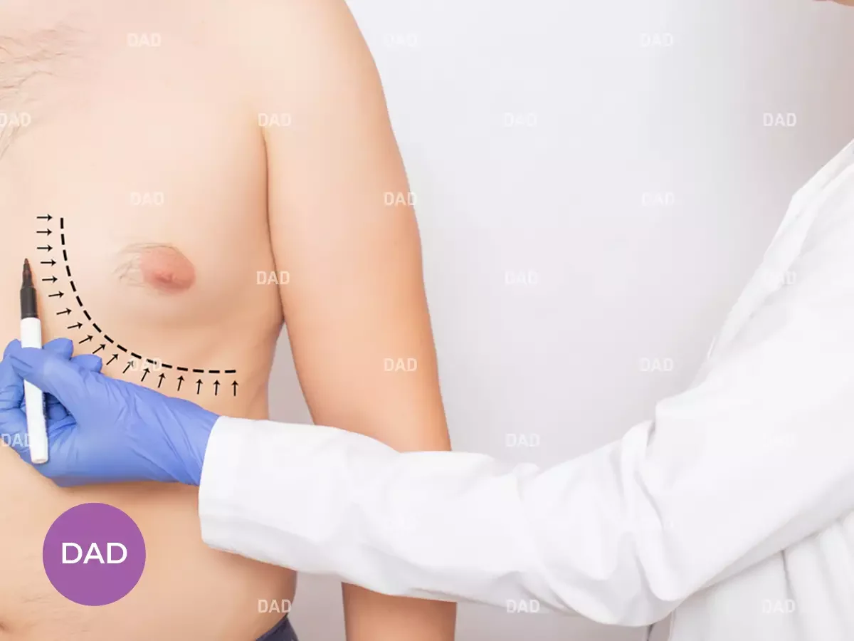 Gynecomastia in bodybuilders