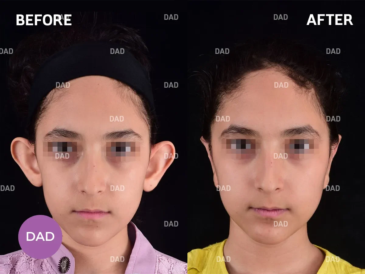 Prominent ear surgery in children