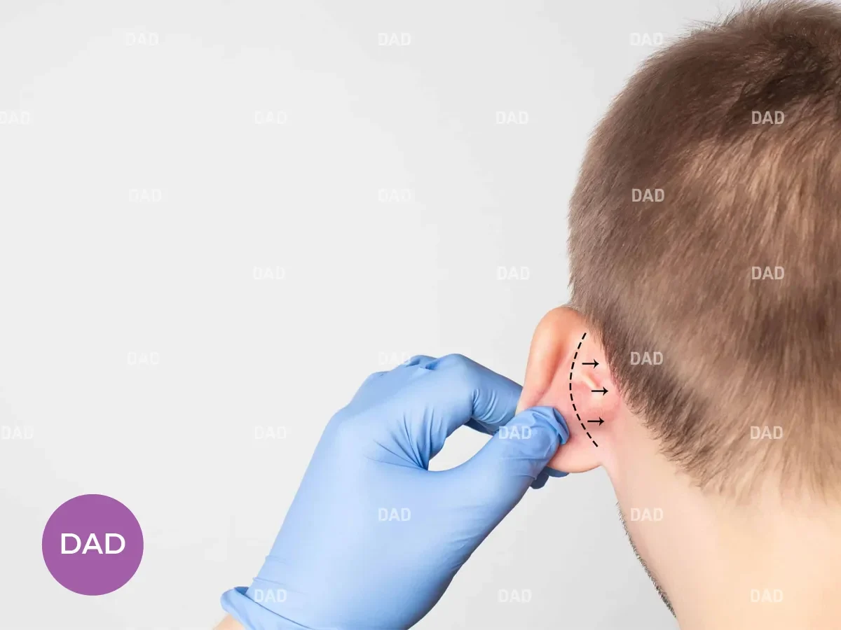 Prominent ear surgery in children