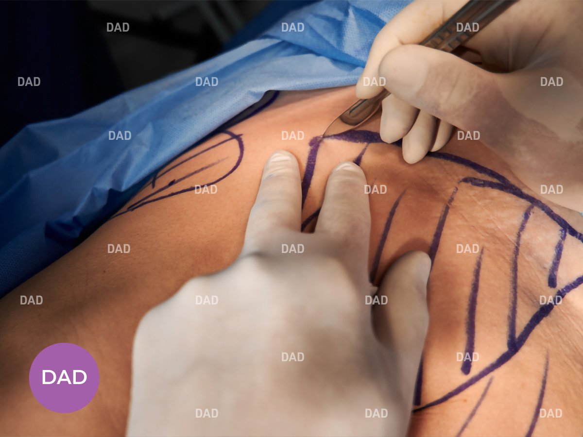 Best Abdominoplasty Surgeon in Tehran