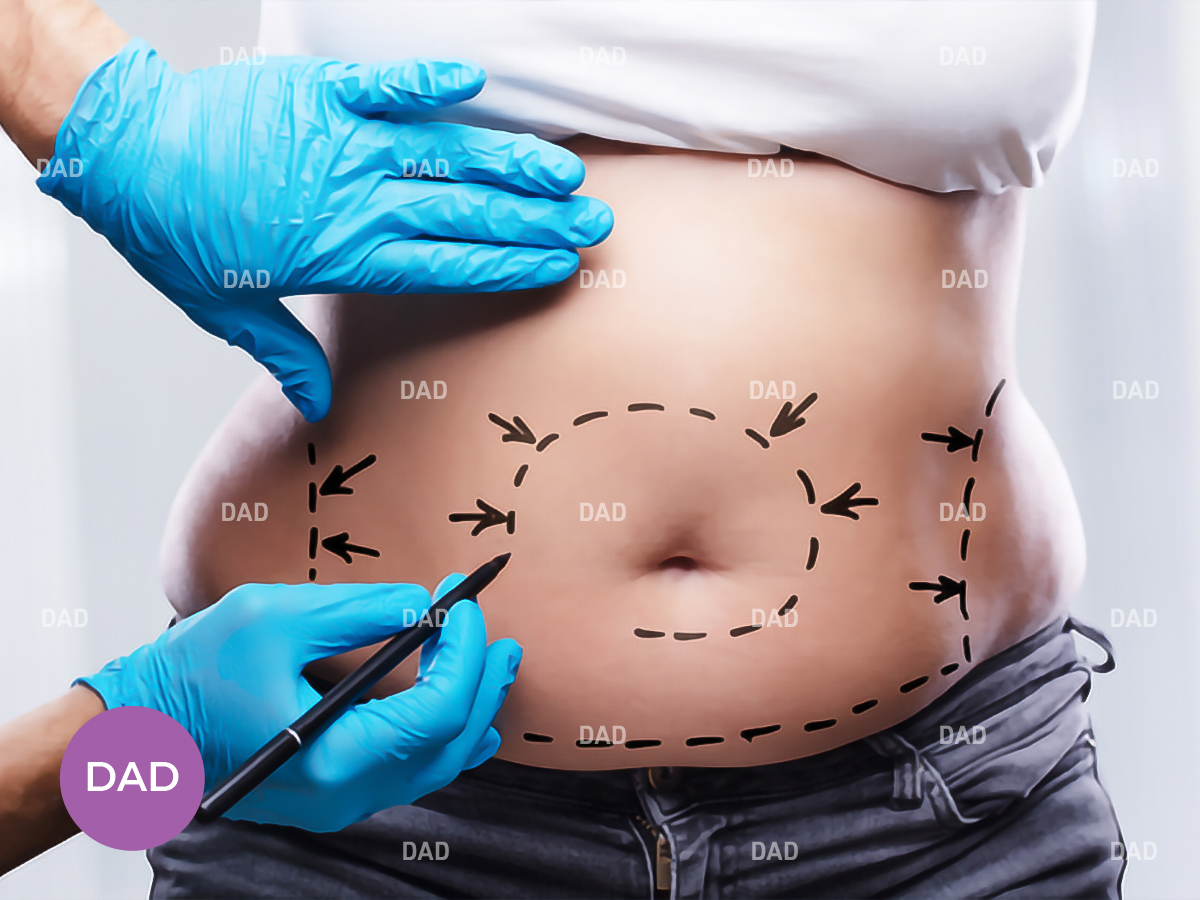 Best Abdominoplasty Surgeon in Tehran